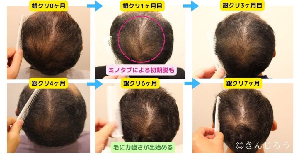 before-after-aga-treatment